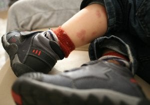 En el 70 por ciento de los casos afecta a niños menores de 5 años. ::
D.V./