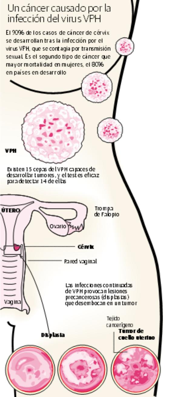 como se detecta el cancer del utero
