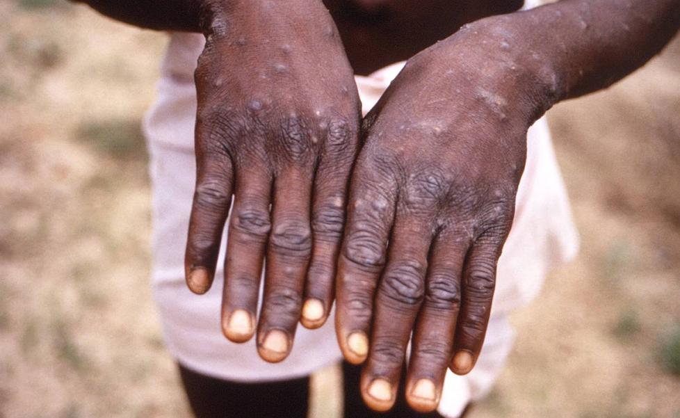 Sanidad plantea comprar vacunas contra la viruela para frenar el virus del mono