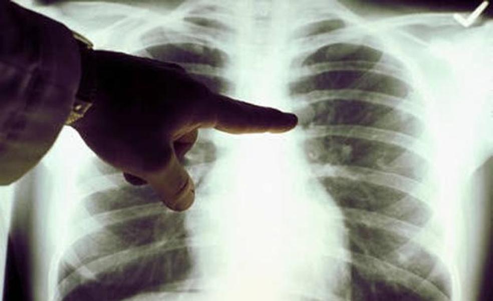 Salud anuncia cribados para el diagnóstico precoz del cáncer de pulmón