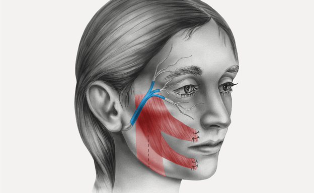 Resfriados que terminan en parálisis facial