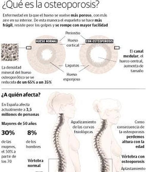 hay osteoporosis en hombres