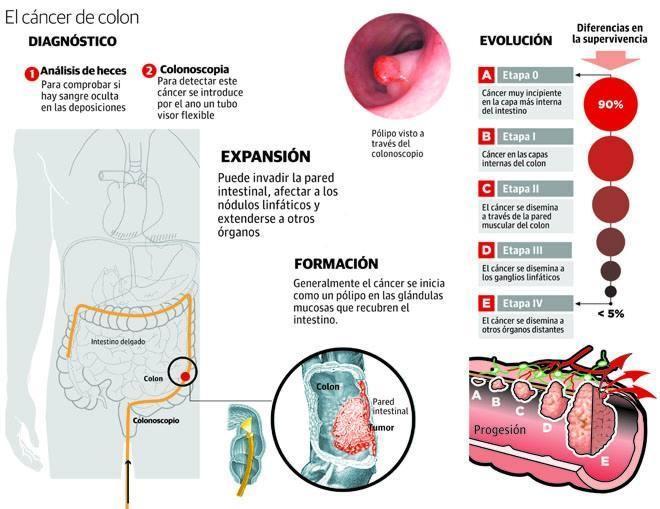 Un centenar de riojanos ha podido atajar un cáncer de colon gracias a la detección precoz