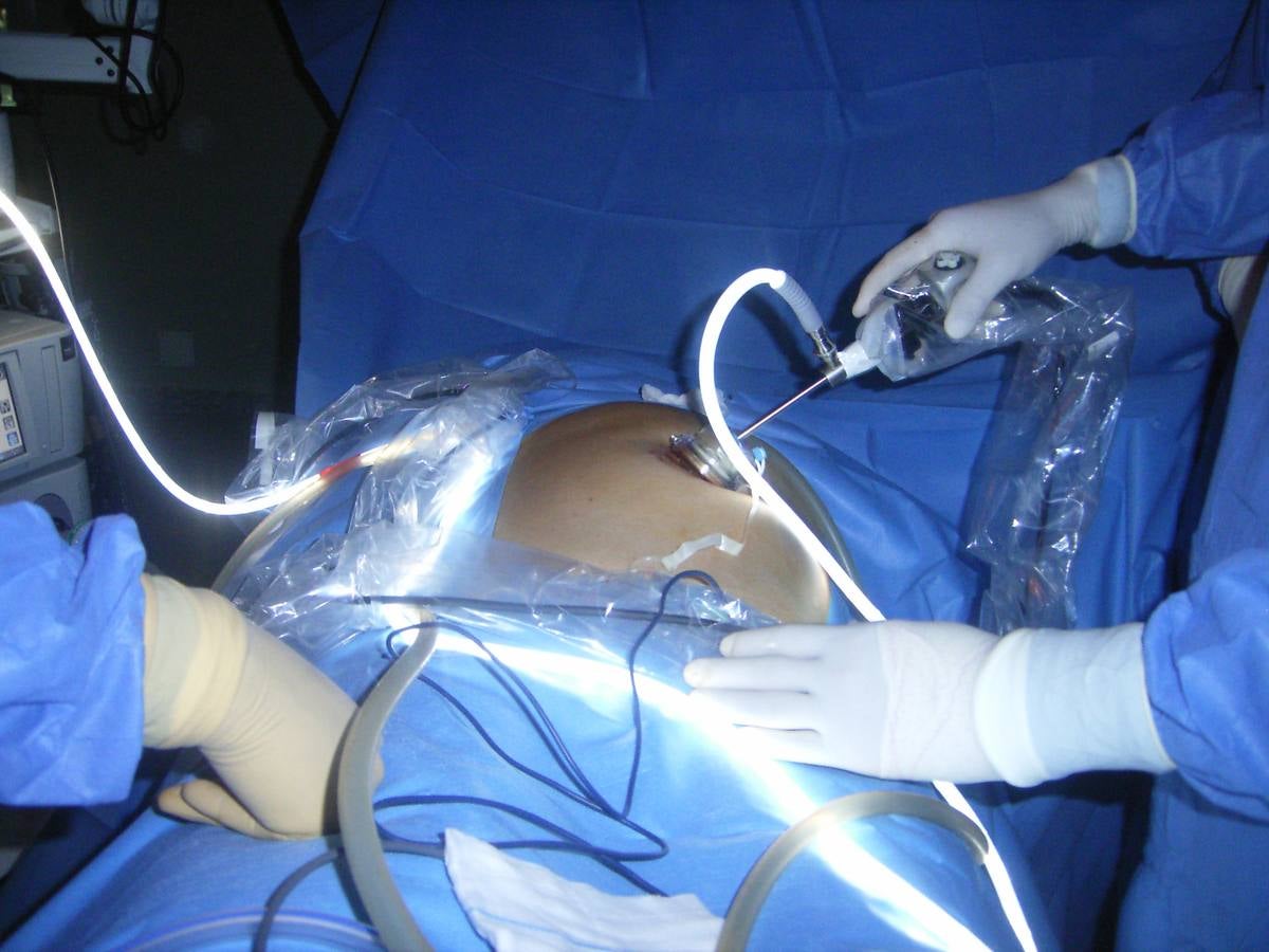 Salud anima a los riojanos a participar en los programas de detección de cáncer de colón